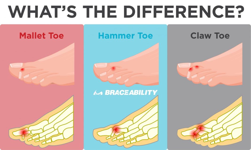 What are the symptoms and causes of Hammer's toe and Mallet Toe